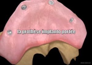 Prothèse implanto-portée